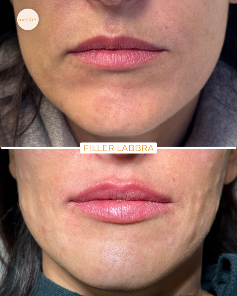 filler labbra meldes