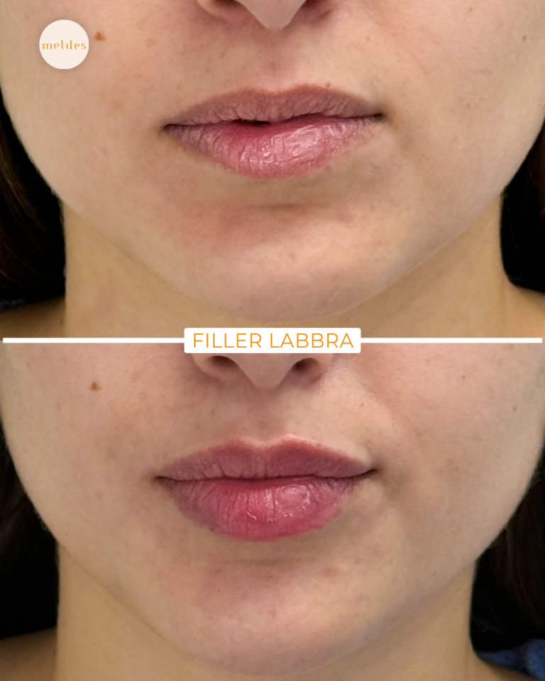 filler labbra meldes