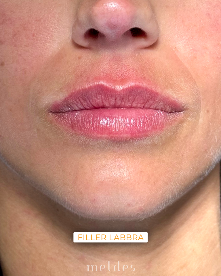 Filler labbra