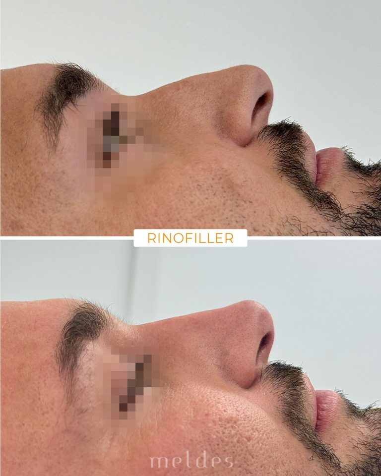 rinofiller meldes milano