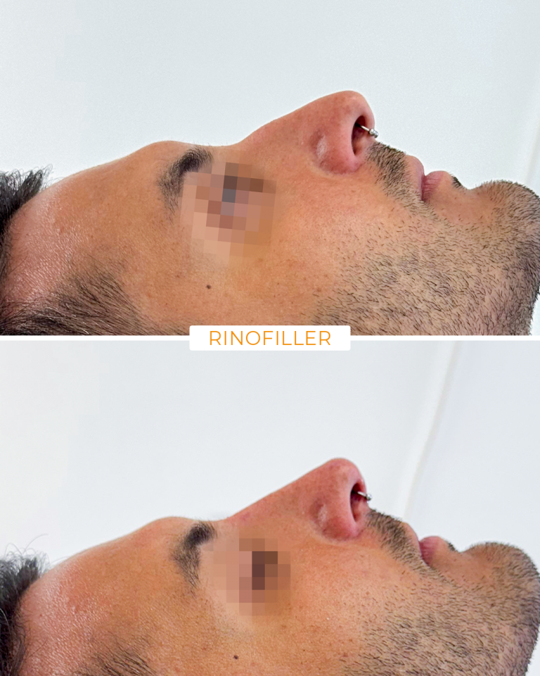 rinofiller meldes