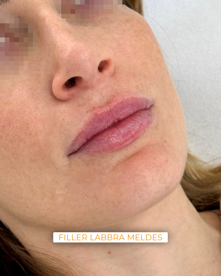 filler labbra milano
