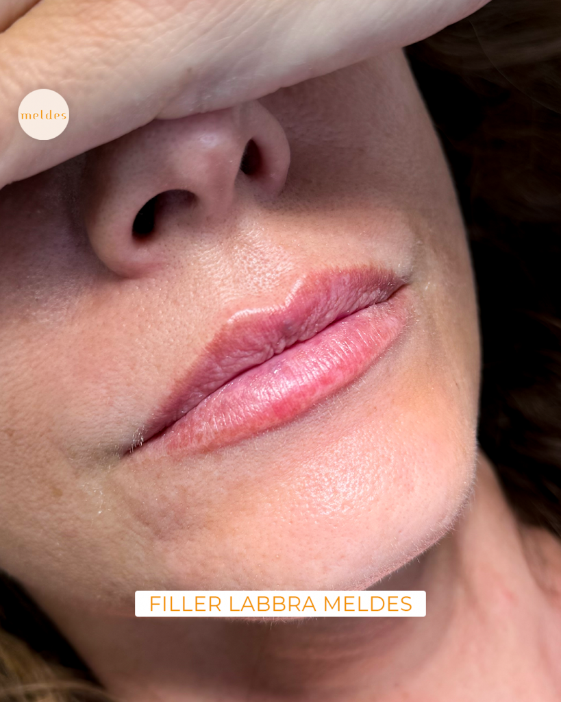 filler labbra luca roberto de santis