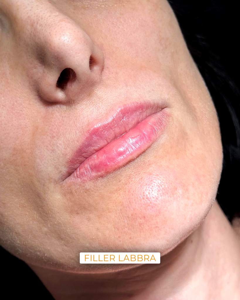 filler labbra meldes