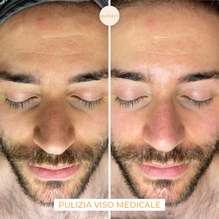 pulizia viso medicale