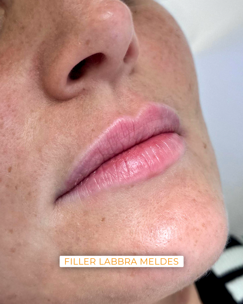 filler labbra meldes