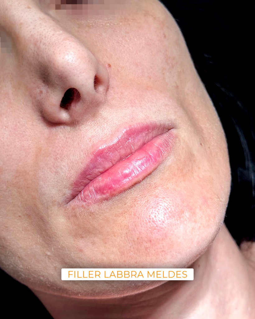 filler labbra meldes