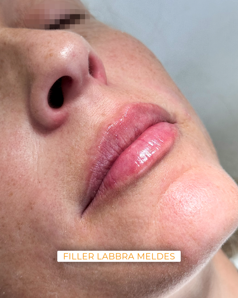 filler labbra meldes