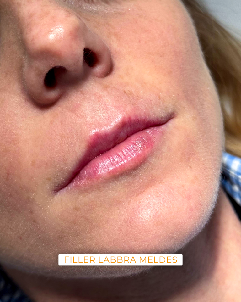 filler labbra meldes