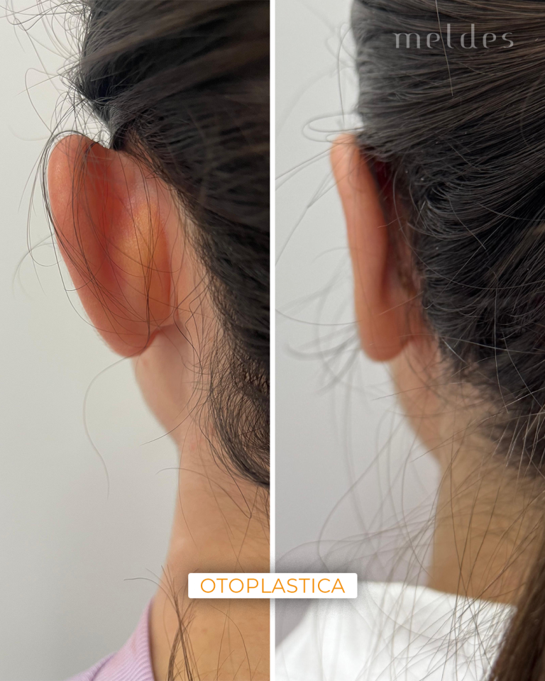 otoplastica
