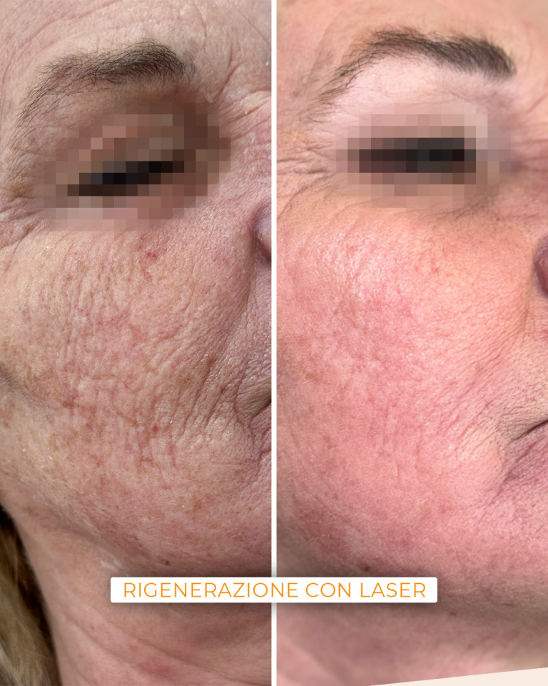 rigenerazione laser